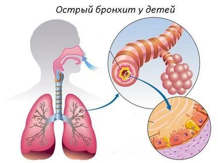 Hogyan működik bronchitis