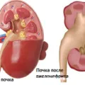 Krónikus pyelonephritis emberek jogorvoslatok