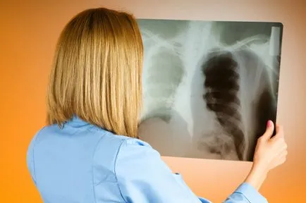 A tuberkulózis kezelésére otthon A tuberkulózis kezelésére otthon