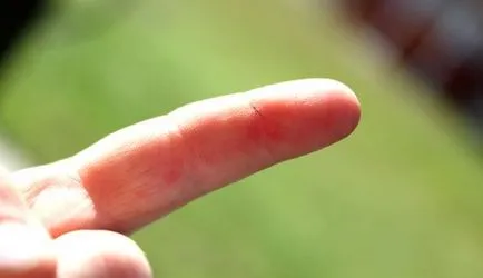 Hogyan lehet eltávolítani a nagyon tüskés Hogyan lehet eltávolítani a nagyon tüskés