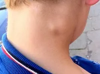 Mi a betegség a leukémia Mi a betegség a leukémia