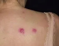 Mi a betegség a leukémia Mi a betegség a leukémia