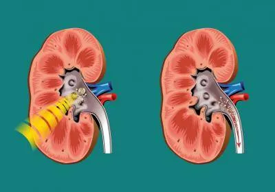 Azt jelenti, kezelésére urolithiasis