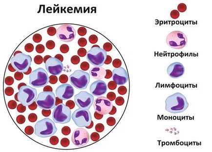 Mi a betegség a leukémia Mi a betegség a leukémia