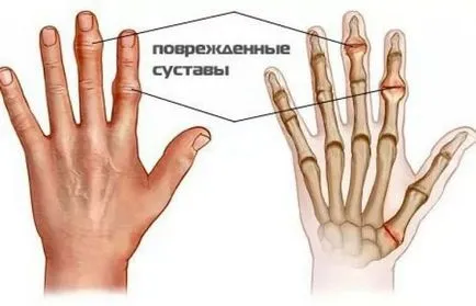 Kezelése arthrosis deformans népi jogorvoslat Kezelése arthrosis deformans népi jogorvoslat