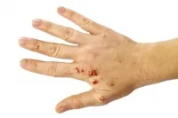 Kezelésére használt készítmények dermatitis Kezelésére használt készítmények dermatitis
