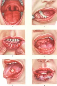 Mi segítséget stomatitis