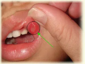 Mi segítséget stomatitis