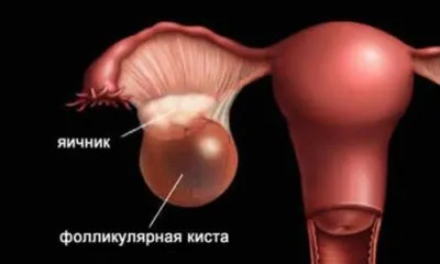 Follicle robban miért nem Follicle robban miért nem