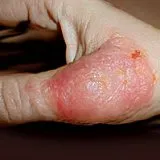 Kezelésére használt készítmények dermatitis Kezelésére használt készítmények dermatitis