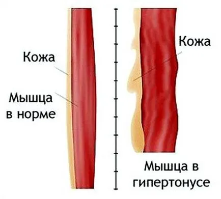 Mert az, hogy az izomtónus
