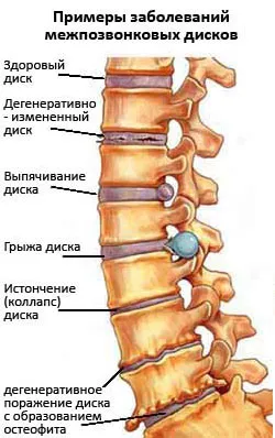 Mi a közös osteochondrosis