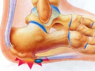 Hogyan kell kezelni sarok homlok Hogyan kell kezelni sarok homlok