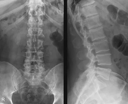 Mi a közös osteochondrosis Mi a közös osteochondrosis