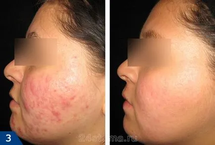Retinoidok, mi ez Retinoidok, mi ez