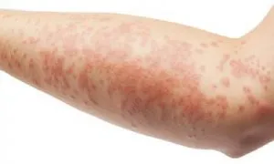 Dermatitis, mit kell tenni