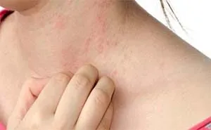 Dermatitis, mit kell tenni