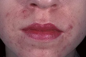 Dermatitis, mit kell tenni
