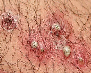 Az impetigo mi ez