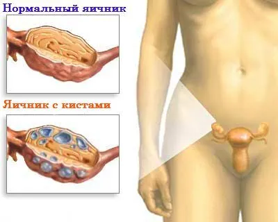 Zsíros gyomor, mint a menstruáció előtt
