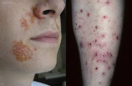 Az impetigo mi ez