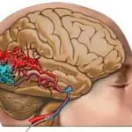 Arteriovenosus fejlődési rendellenesség okoz, tünetek és a kezelés