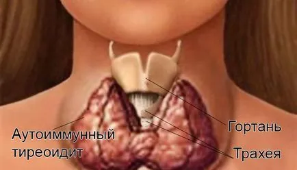 Autoimmun pajzsmirigy pajzsmirigy