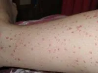 Purpura a lábon okoz gyermekeknél és felnőtteknél