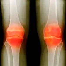 Gonarthrosis kezelt emberek jogorvoslatok