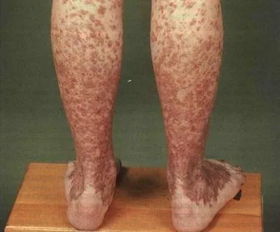purpura