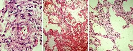 purpura