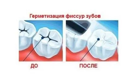 Tömítő fogak gyermekeknél vélemények arról, hogy ezt a Barázdazárás szüksége