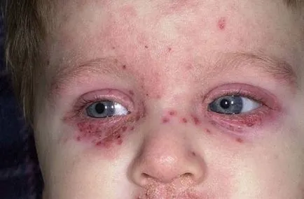 Purpura a lábon okoz gyermekeknél és felnőtteknél