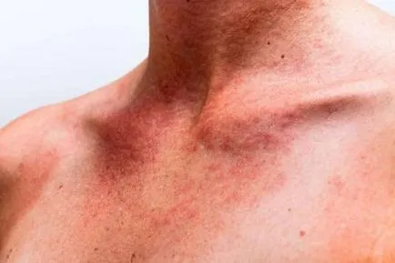 Purpura a lábon okoz gyermekeknél és felnőtteknél