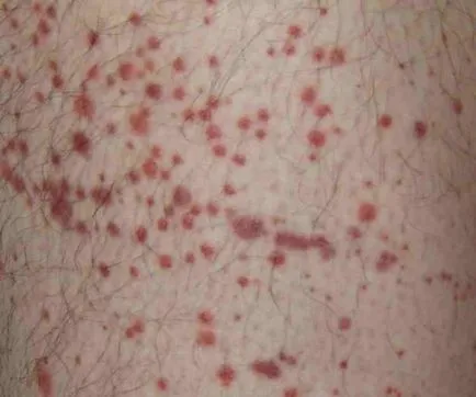 Purpura gyermekkorban okoz, tünetei, kezelése