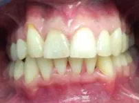 Malocclusion felnőtteknek - Utána képek, vélemények, árak (utána) Malocclusion felnőtteknek - Utána képek, vélemények, árak
