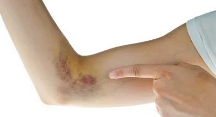 Hogyan lehet gyorsan megszabadulni a zúzódás vagy haematoma