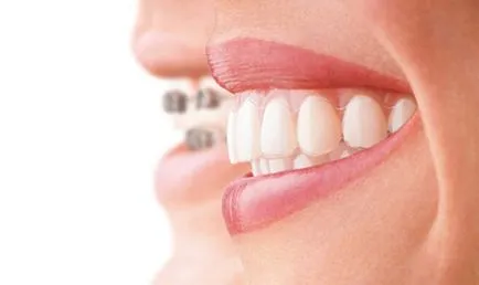 Malocclusion felnőtteknek, önköltség Ufa korrekció, fotó, Ufa (Ufa) Malocclusion felnőtteknek, önköltség Ufa korrekció, fotó, Ufa