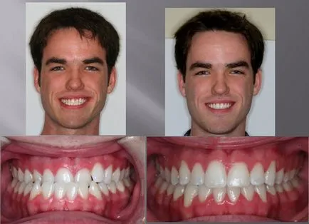 Malocclusion felnőtt kezelések és az árak, dentalsolution fogászati szolgáltatások (harapás korrekció) Malocclusion felnőtt kezelések és árak, fogászat szolgáltatások dentalsolution