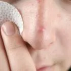 Hogyan és mit kell kezelni a forraljuk az arcodon, amit tudnod kell - szakértői vélemény