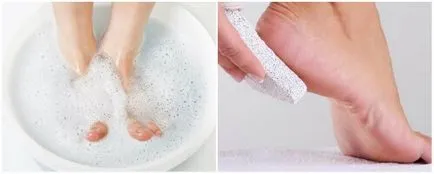 Hogyan lehet megszabadulni a tyúkszem a láb hazai jogorvoslati