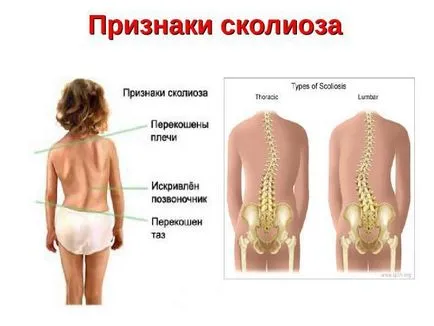 Hogyan állapítható meg, a gerincferdülés otthoni diagnosztikai módszerek eltérései