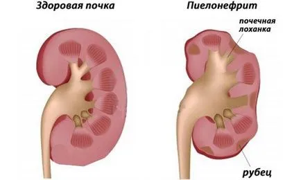 Pyelonephritis antibiotikus kezelés