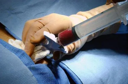 Hogyan lesz egy csontvelő donor Magyarországon (Cikk) Hogyan lesz egy csontvelő donor Magyarországon