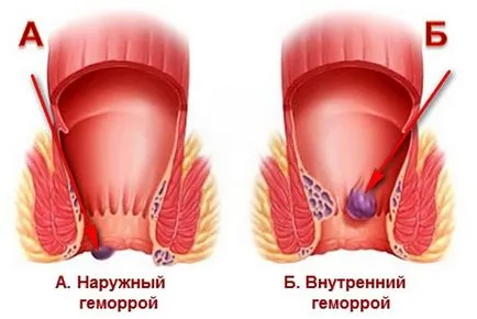 Hogyan lehet gyógyítani aranyér népi jogorvoslati (aranyér) Hogyan lehet gyógyítani aranyér népi jogorvoslati