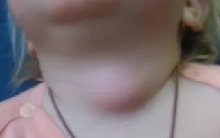 Ciszta nyak - okok és tünetek a nyaki ciszták