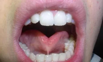 Tongue-tie