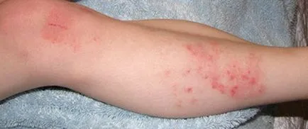 Skin dermatitis fotó kezelés gyermekek, felnőttek, kenőcsök, tüneteket okoz