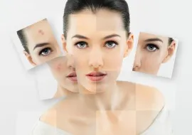 A kezelés utáni acne, hogyan lehet megszabadulni a - a legjobb eszköz a foltok (megszabadulni) post-akne kezelés, hogyan lehet megszabadulni - a legjobb orvosság foltok