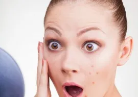 A kezelés utáni acne, hogyan lehet megszabadulni a - a legjobb eszköz a foltok (kezelés) post-akne kezelés, hogyan lehet megszabadulni - a legjobb orvosság foltok